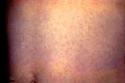 Rubella rash on the abdomen