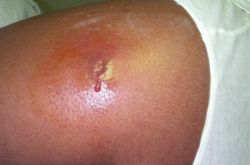 An abscess caused by methicillin-resistant Staphylococcus aureus bacteria (MRSA).