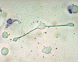 A macrophage stretching its arms to engulf two particles. Reactive oxygen species promote oxidized LDL and polyphenol antioxidants combat this inflammatory response.