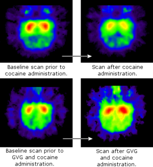 Positron Emission Tomography scans showing the average level of dopamine receptors in six primates' brains. Red is high- and blue is low-concentration of dopamine receptors. The higher the level of dopamine, the fewer receptors there will be.